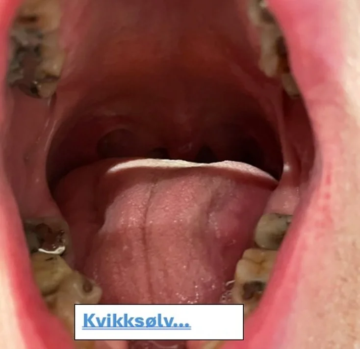 Illustrasjon til innlegg om amalgamfyllinger og kvikksølv